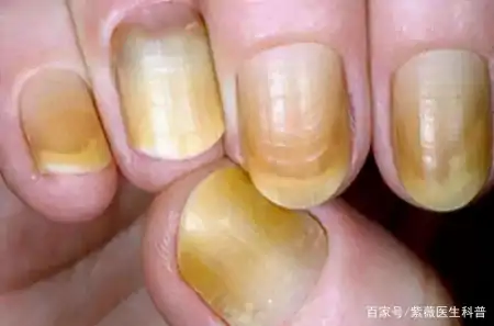 指甲有月牙代表健康吗（指甲上的月牙越多越健康吗?）