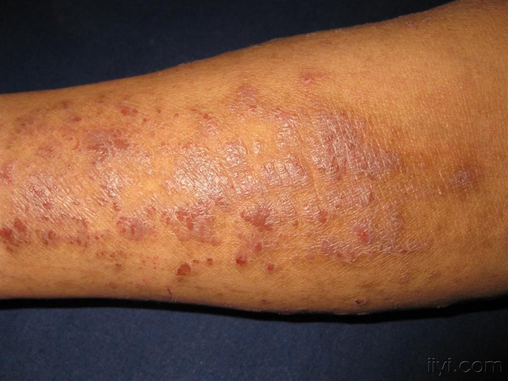 八大常见皮疹的症状和诱因