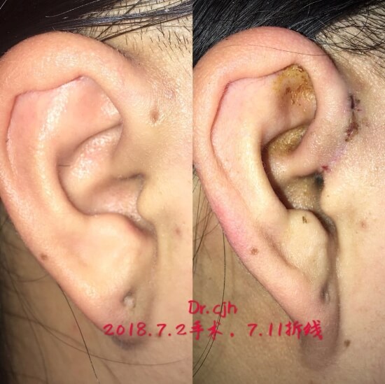 先天性耳前瘘管反复感染，有必要切除吗？