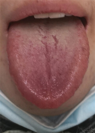 舌头有裂纹，可能是天生，也可能是胃阴不足。后者需要及时调理