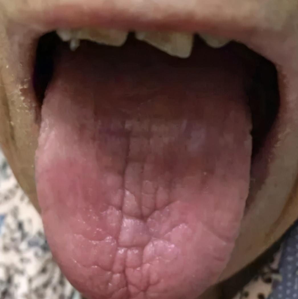 中医舌诊：舌头为什么会出现裂纹？分四种原因