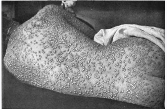 历史中常见的天花病毒是如何被消灭的?