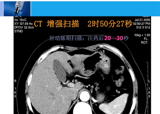 肝脏嗜酸性粒细胞浸润的CT和MRI征象分析