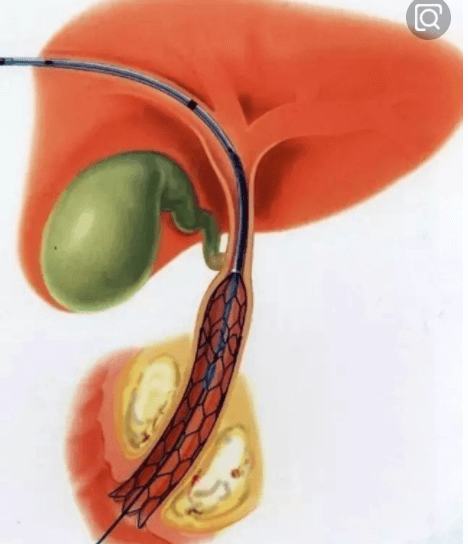 胆管肿瘤的治疗方法和术后调理（2）