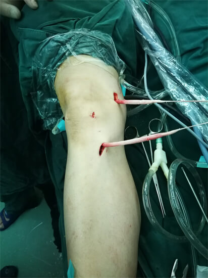 膝关节韧带重建的八大热点问题，患者：看完终于知道怎么决定了！