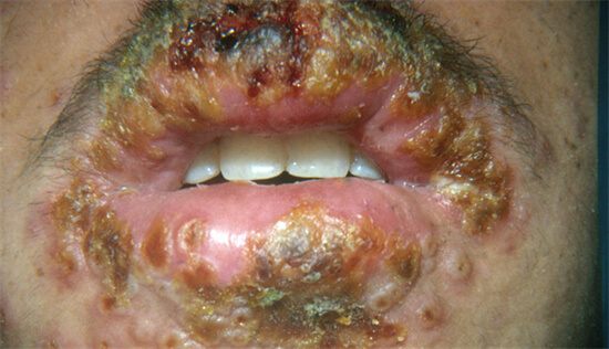 疱疹有哪些症状？