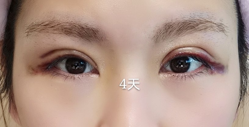 韩式三点43天，双眼皮恢复的很自然了